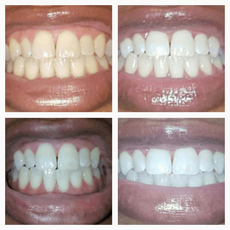 BrightSmile Whitening Pen