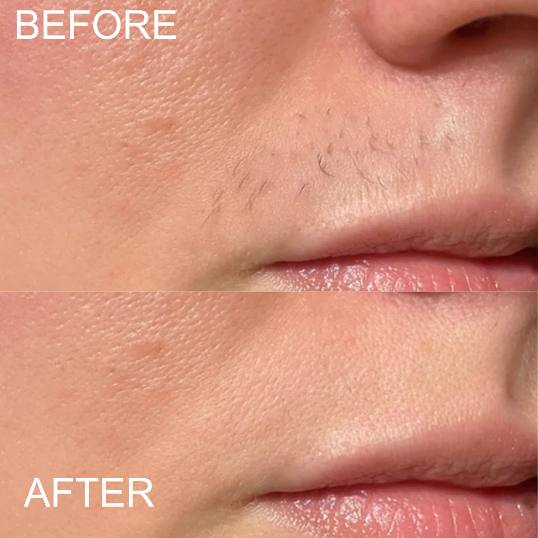 Facial Hair Remover