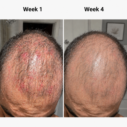 Scalp Light Therapy Cap