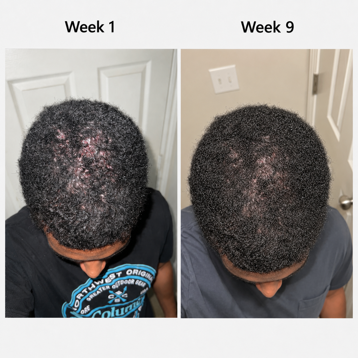 Scalp Light Therapy Cap