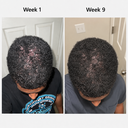 Scalp Light Therapy Cap