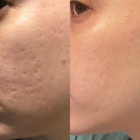 Reusable Anti-Wrinkle Sleep Patches