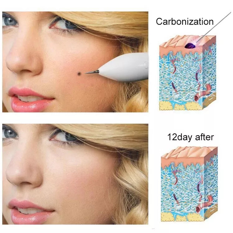 ClearLift Plasma Therapy Kit