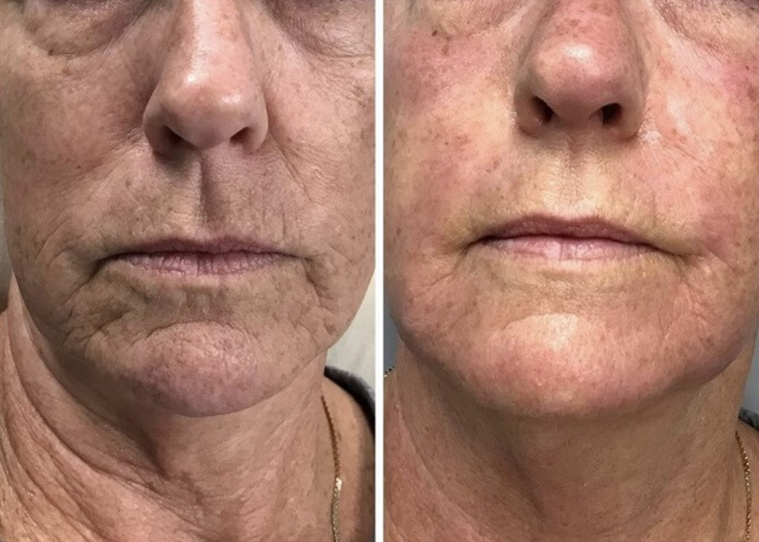 SkinRenew Pro