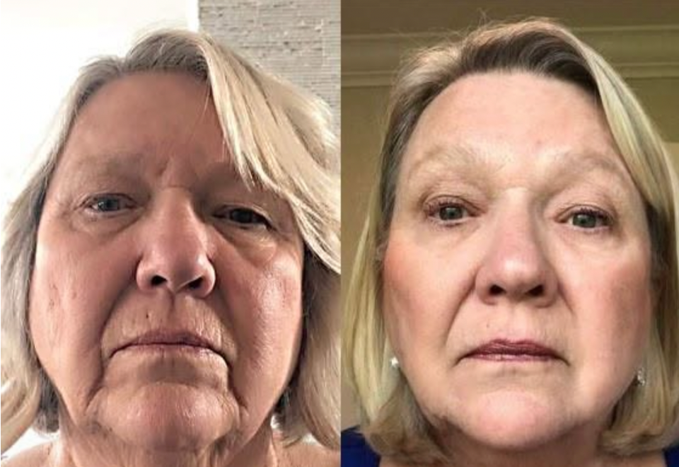 SkinRenew Pro
