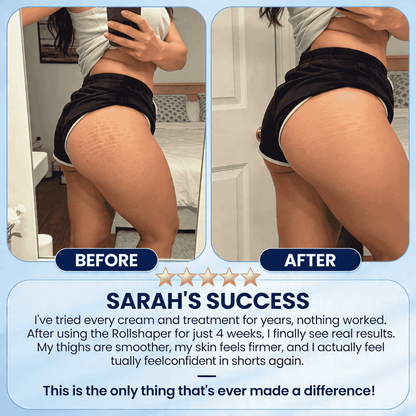 Cellulite Reduction Rollshaper