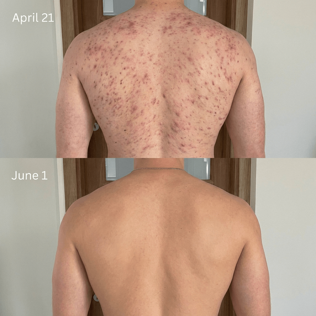ClearReach Bacne Treatment
