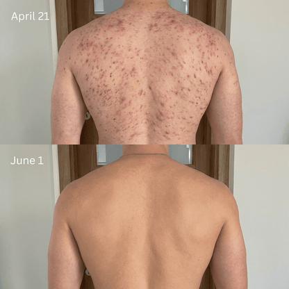 ClearReach Bacne Treatment