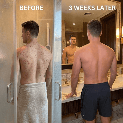 ClearReach Bacne Treatment