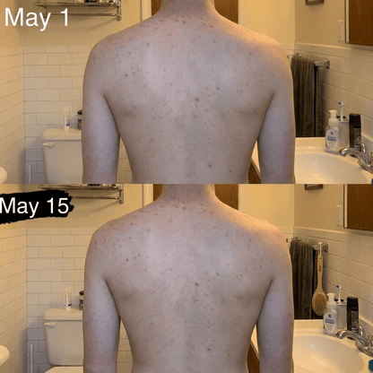 ClearReach Bacne Treatment