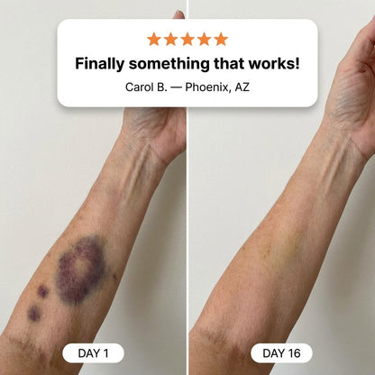Bruise Repair Cream